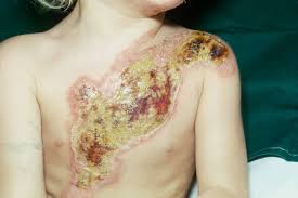 Most complications caused by constricting burn eschar develop several hours into resuscitation as progressive edema. Burns Clinical Advisor