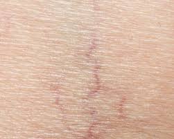 The process may be a bit difficult, especially for the face, as it could leave some scar on the face, due to the application of electric current. Common Causes Of Spider Veins On Face And Natural Treatment Tips