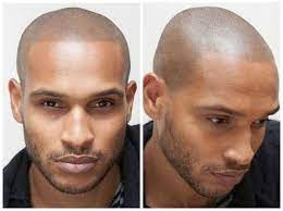 Men Have Found A Unique Solution To Hiding Male Pattern Baldness Male Pattern Baldness Pattern Baldness Balding