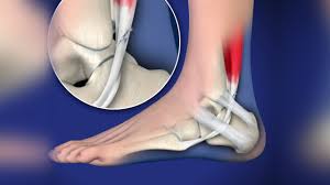 Foot join… digits of foot. Peroneal Tendon Injuries Foot Ankle