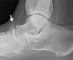 The dpn is most commonly entrapped at the inferior edge of the extensor retinaculum where the extensor hallucis brevis crosses over top. Us And Mr Imaging Of The Extensor Compartment Of The Ankle Radiographics
