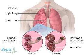 The disease is characterized by chronically poor airflow which worsens as time goes on. Chronic Obstructive Pulmonary Disease Copd
