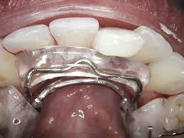 An inman aligner is a removable dental aligner. Straight Teeth In Just 6 Weeks Inman Aligner How The Cheaper Faster Alternative To Costly Clear Braces Can Perfect Your Smile Traceybell Liverpool Isle Of Man