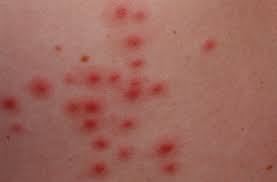 How to eliminate hot tub bacteria. Folliculitis Causes Signs Symptoms How To Get Rid Of Folliculitis