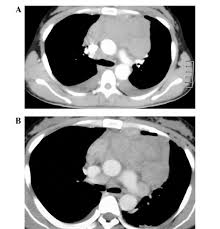 mesothelioma is a type of cancer that develops from the thin layer of tissue that covers many of the internal organs (known as the mesothelium). Giant Malignant Mesothelioma In The Upper Mediastinum A Case Report