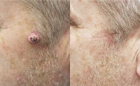 The strongest risk factor for developing skin cancer is ultraviolet (uv) ray exposure, typically from the sun. Private Skin Cancer Treatment Skin Surgery Clinic