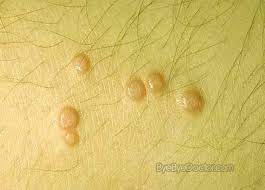 Ang ingrown hair vs genital warts panimula: Ingrown Hair Genital Warts Vs Ingrown Hair