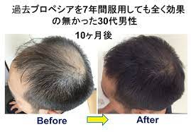 octa wellness発毛とagaクリニックとの違い 男性向け発毛専門店のブログ 発毛 薄毛 aga 治療