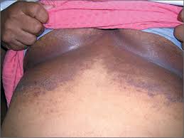 Image result for Candidiasis under breasts