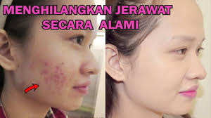 Ini cara menghilangkan bekas jerawat membandel menurut ahli dermatologi. Cara Menghilangkan Jerawat Bekas Jerawat Dengan Cepat Dan Alami Youtube