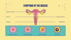 At the initial stages, the first signs are indeterminate and uncharacteristic, more manifesting as the tumor grows. Cervical Cancer Study Google Slides Ppt Theme