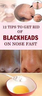 Blackheads Are Just Clogged Hair Follicles That Are Visible Blackheads On Nose Get Rid Of Blackheads Saggy Skin