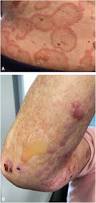 Image result for Pemphigoid