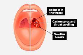 How To Get Rid Of A Sore Throat Faster Tua Saude
