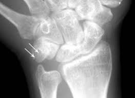 Image result for Pisiform Bone
