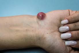 With a problem like ingrown pubic hair, anyone who removes unwanted vegetation in an intimate zone faces. How Do You Treat An Ingrown Hair Cyst