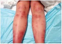 Image result for erythema nodosum