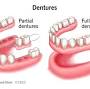 Dental Dentures from my.clevelandclinic.org