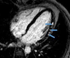 Symptoms can include chest pain, shortness of breath, or palpitations. Myocarditis In The Athlete American College Of Cardiology