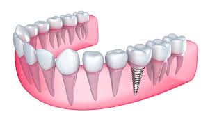 Hiossen implant is considered one of the leading five dental implant companies. Ne Calgary Dental Implants Memorial Square Dental Clinic