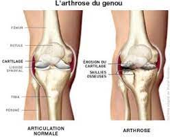 Le plus surprenant c'est que ça ne fait mal que quand je cours, pas quand je fais du vélo ou de la marche même en forçant dessus. Douleur Au Genou Les 5 Causes De Douleurs Selon L Osteopathe