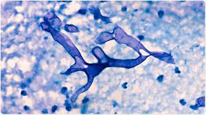 It's relatively rare, but also very serious. Cual Es Mucormicosis