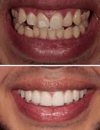 Veneers Vs Lumineers Best Dentists In Los Angeles For Veneers