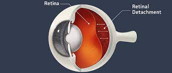 Tiny specs or floaters that drift through your field of vision. Retinal Detachment Symptoms Signs And Treatment 1 Eye Doctor Optometrist In Chicago S Chinatown