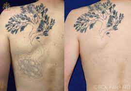 Clean the skin with warm water. Laser Tattoo Removal St George Salt Lake City Utah Patel Plastic Surgery
