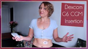How does the dexcom g6 work. Dexcom G6 Sensor Insertion Youtube