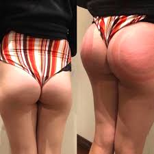 3b scientific® supply for science, medical, & patient education today! Services Pricing Butt Cupping