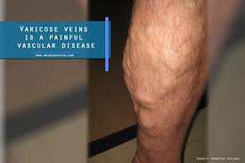 We did not find results for: 8 Varicose Veins Myth You Should Not Believe Oriole Physiotherapy Rehabilitation Center