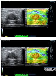 Lee bon leong & co. Similar Reproducibility For Strain And Shear Wave Elastography In Breast Mass Evaluation A Prospective Study Using The Same Ultrasound System Ultrasound In Medicine And Biology