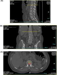 Comparison Between The Mdct And The Dxa Scanners In The Evaluation Of Bmd In The Lumbar Spine Densitometry Sciencedirect