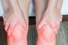 Image result for gout symptoms knee