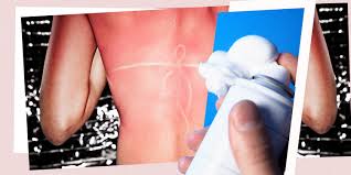 Discover softsheen carson's razorless shaving powder for coarse textured hair. Menthol Shaving Cream On Sunburns Does It Really Work