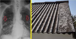 Jangkitan ini tidak hanya menular tetapi juga boleh membawa akibat. Jangkitan Paru Paru Punca Simptom Dan Rawatan The Diagnosa