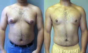What does breast cancer look like on mammograms? Man Boobs Causes Exercises And More