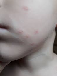 Image result for vyrážka u dětí