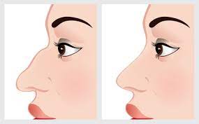 Vereinbaren sie mit diesem bekannten plastischen chirurgen aus beverly hills babak azizzade. Rhinoplastik Kann Zu Einer Leichten Veranderung Der Stimme Fuhren