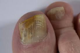 fungal nail infection nhs