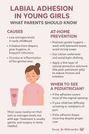 Image result for Labial Fusion