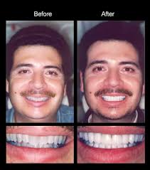 Cerritos Dentist Smile Gallery-Dr. Jay Azling