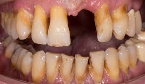 Untreated periodontitis will eventually result in tooth loss. What Happens When Gum Disease Is Allowed To Progress Dentist In Palmdale Ca