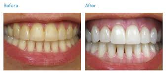 How much does zoom whitening cost. Cost Of Professional In Office Teeth Whitening Brands In Nycdr Jacquie