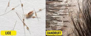 Image result for lice vs dandruff