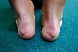 A ridge of bone along the posterior superior lateral ridge of the calcaneus often causing bursal inflammation of the achilles bursa and often associated with calcification or spur of the. Pictorial Case Study Heel Pain Gponline