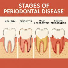 Image result for Periodontitis