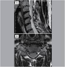 We did not find results for: Scielo Brasil Cervical Endoscopic Disc Surgery Precise Approach For Minimally Invasive Decompression Cervical Endoscopic Disc Surgery Precise Approach For Minimally Invasive Decompression