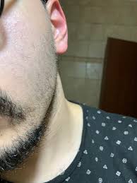 5,6 alopecia areata is common in children and young adults and is seen less often in older age groups with graying hair. Is My Beard Growing Back Just Wondering If These White Hairs Are Gonna Turn Black Soon Would Appreciate If Anyone Who Cured From Alopecia Give Some Feedback Alopecia